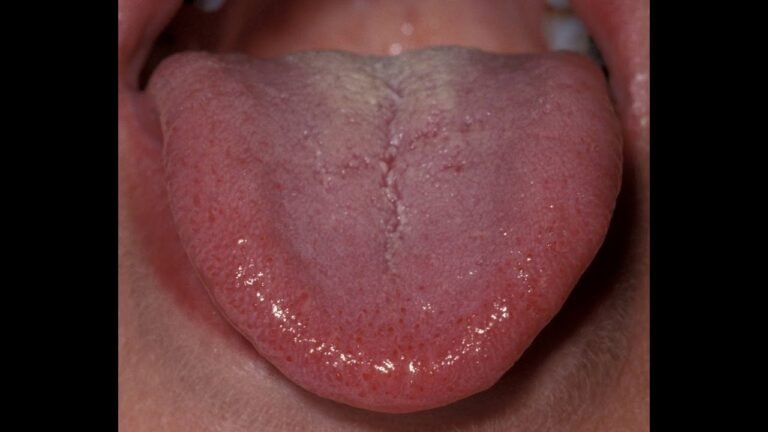 Puntitos rojos en la lengua: causas y tratamiento