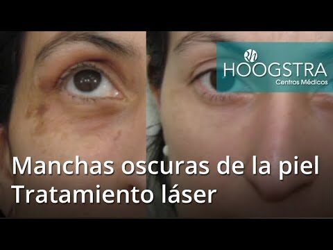 Tratamiento con láser para eliminar manchas oscuras: una solución efectiva