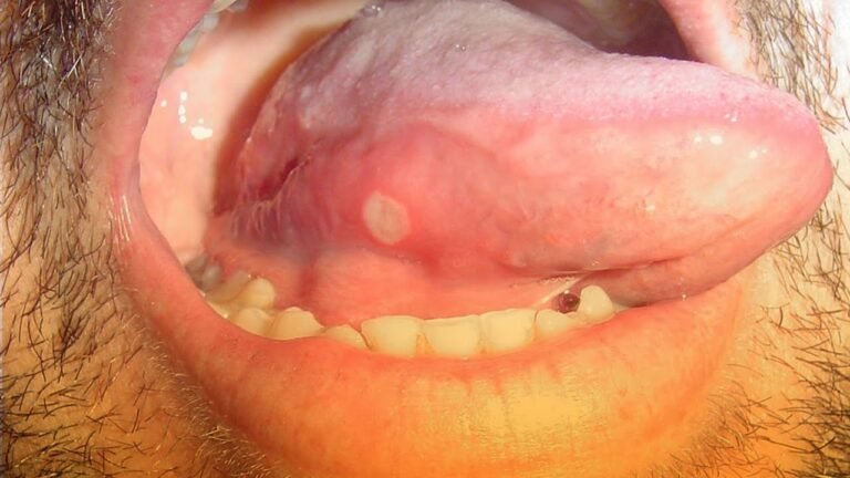 ¿Por qué salen llagas en la lengua? Descubre las causas y cómo tratarlas